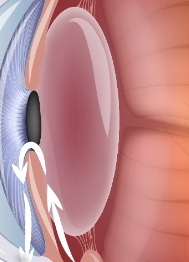 Glaucoma Horizons